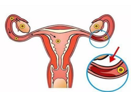 重庆试管婴儿价格：乳房下垂怎样恢复紧实,小方法告别下垂